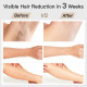 Bosidin IPL Laser System - At Home Laser Hair Removal Bosidin IPL Laser System - At Home Laser Hair Removal